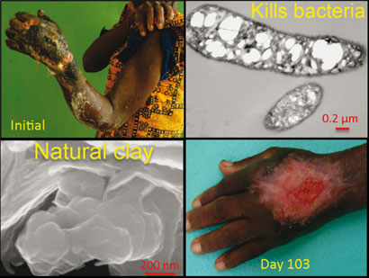 Hand infected with buruli ulcer and micrographs of clay and killed bacteria