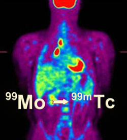 Nuclear medicine scan